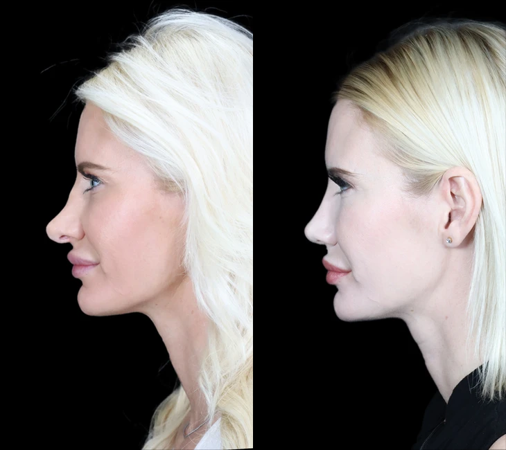 Rhinoplasty before and after photos by Noses and Necks NYC in New York, NY