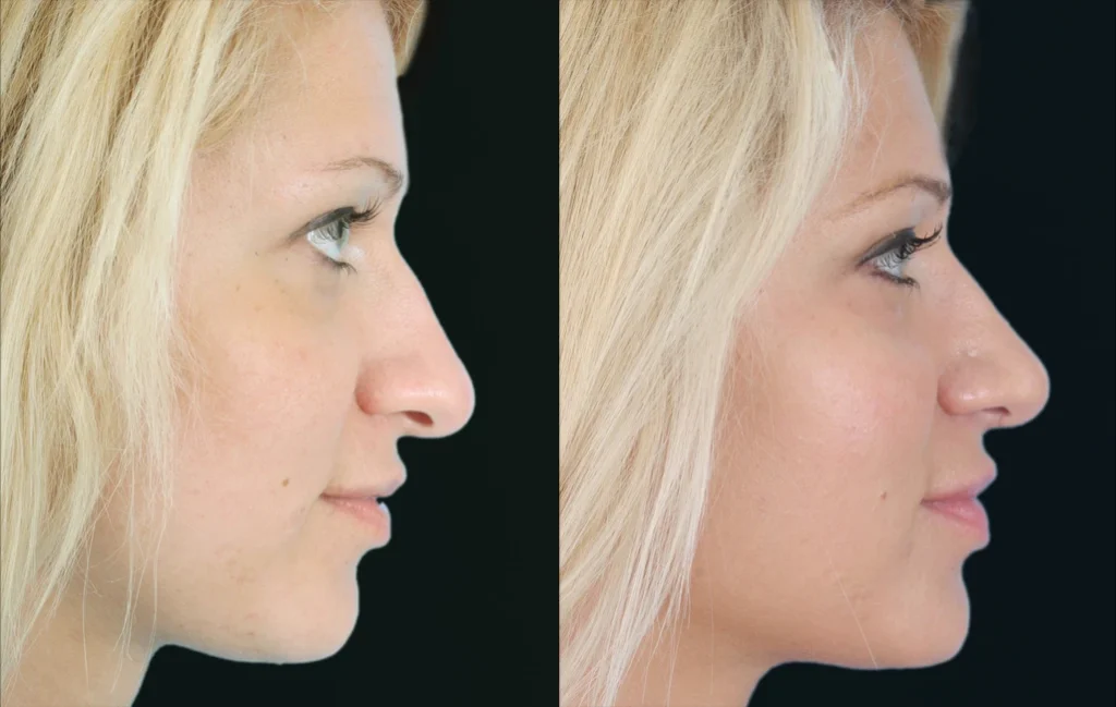 Rhinoplasty before and after photos by Noses and Necks NYC in New York, NY
