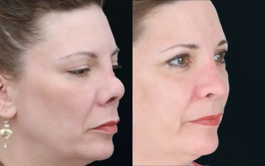 Rhinoplasty before and after photos by Noses and Necks NYC in New York, NY