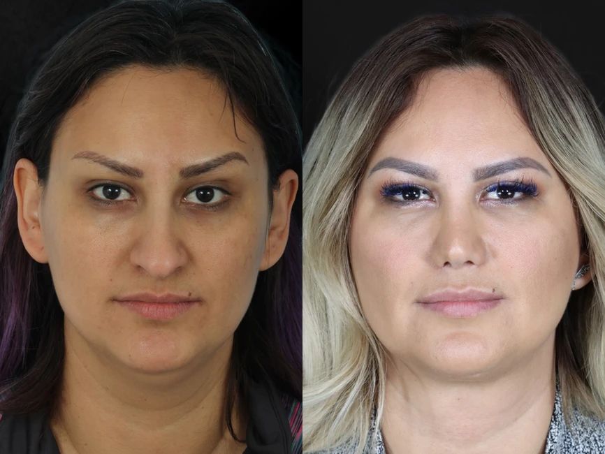 Rhinoplasty before and after photos by Noses and Necks NYC in New York, NY