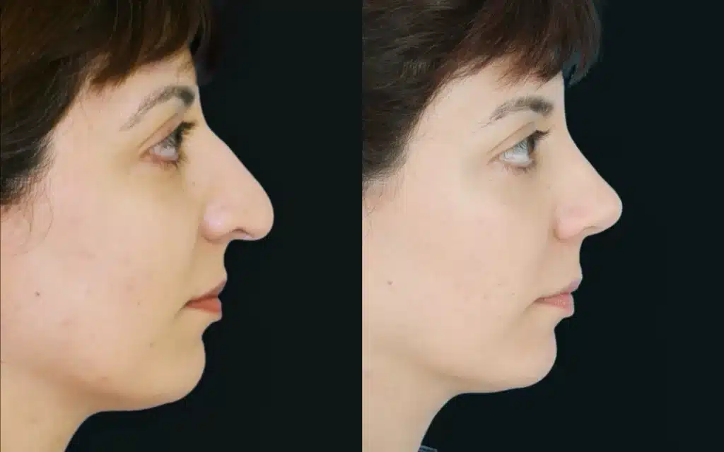 Rhinoplasty before and after photos by Noses and Necks NYC in New York, NY