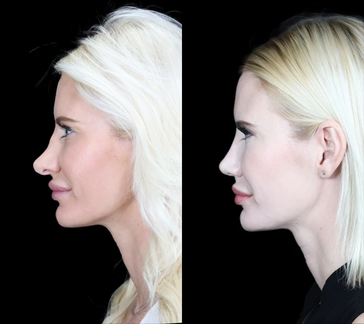 Rhinoplasty before and after photos by Noses and Necks NYC in New York, NY