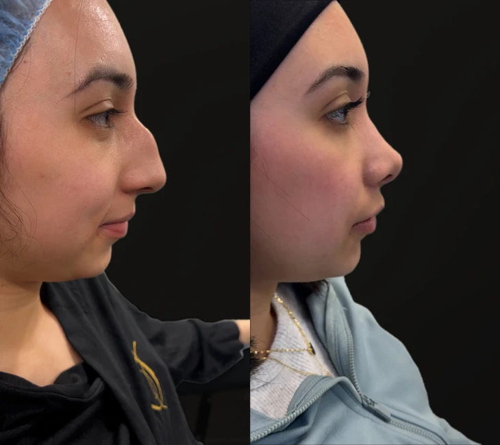 Rhinoplasty before and after photos by Noses and Necks NYC in New York, NY