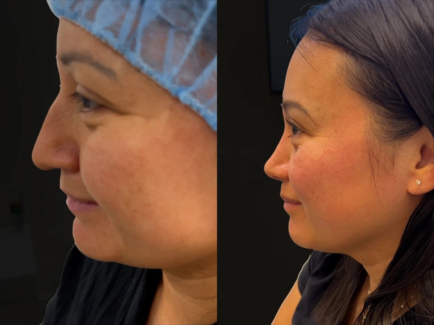 Rhinoplasty before and after photos by Noses and Necks NYC in New York, NY