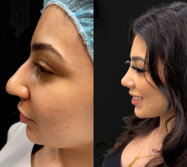 Rhinoplasty before and after photos by Noses and Necks NYC in New York, NY