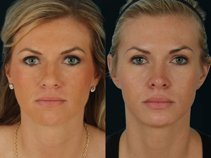 Rhinoplasty before and after photos by Noses and Necks NYC in New York, NY