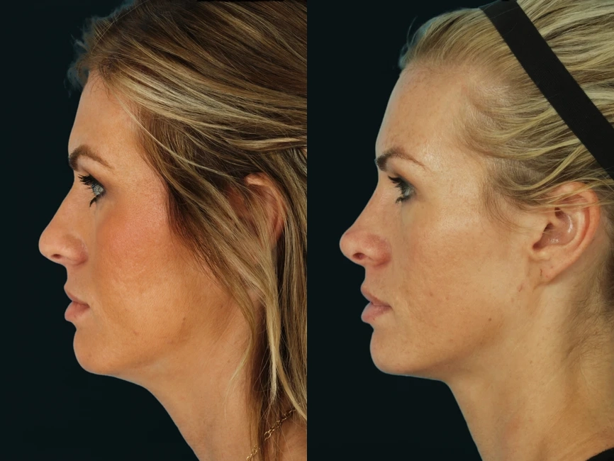 Rhinoplasty before and after photos by Noses and Necks NYC in New York, NY Rhinoplasty before and after photos by Noses and Necks NYC in New York, NY
