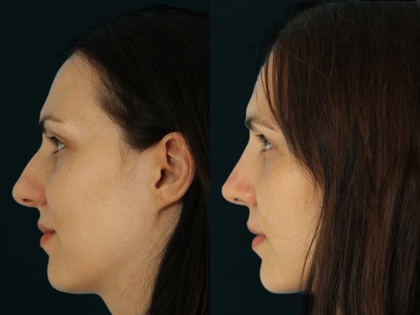Rhinoplasty before and after photos by Noses and Necks NYC in New York, NY