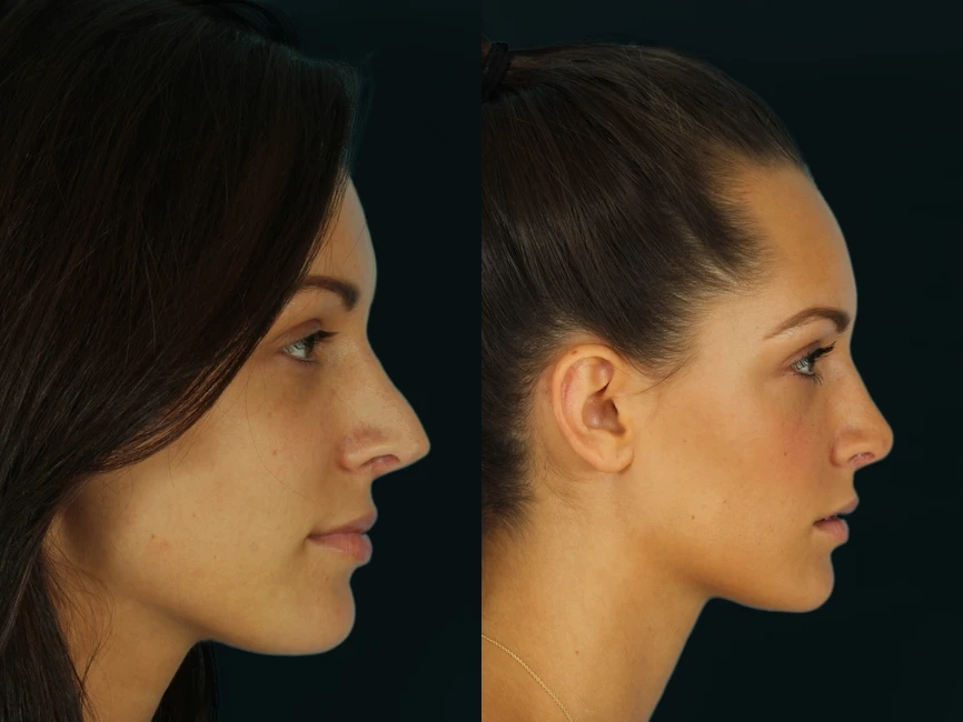 Rhinoplasty before and after photos by Noses and Necks NYC in New York, NY