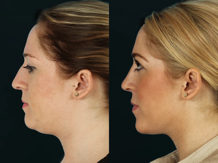 Rhinoplasty before and after photos by Noses and Necks NYC in New York, NY
