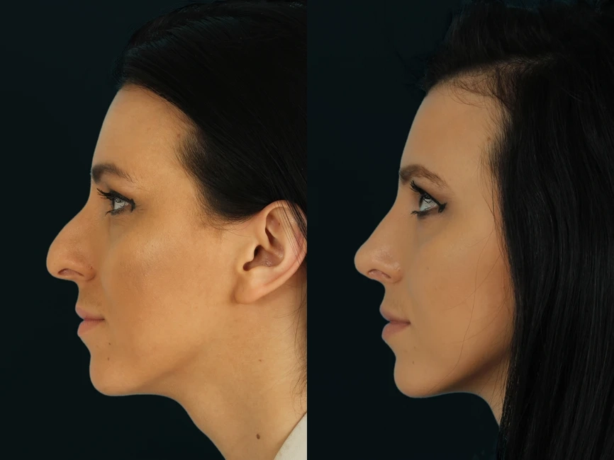 Rhinoplasty before and after photos by Noses and Necks NYC in New York, NY
