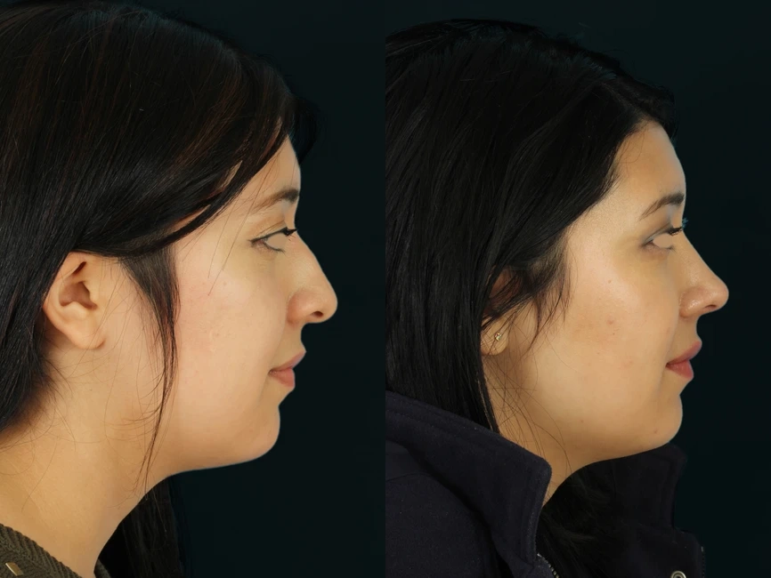 Rhinoplasty before and after photos by Noses and Necks NYC in New York, NY