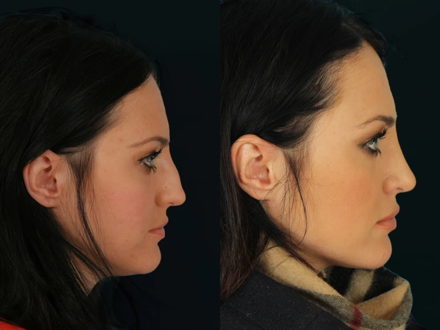 Rhinoplasty before and after photos by Noses and Necks NYC in New York, NY