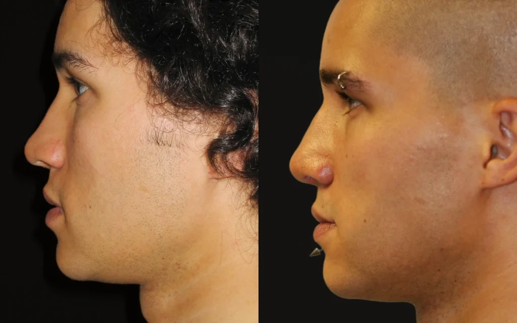 Rhinoplasty before and after photos by Noses and Necks NYC in New York, NY