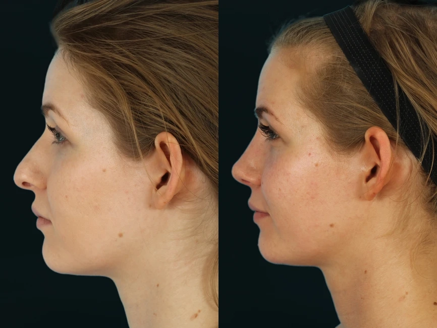 Rhinoplasty before and after photos by Noses and Necks NYC in New York, NY