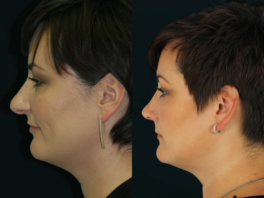 Rhinoplasty before and after photos by Noses and Necks NYC in New York, NY