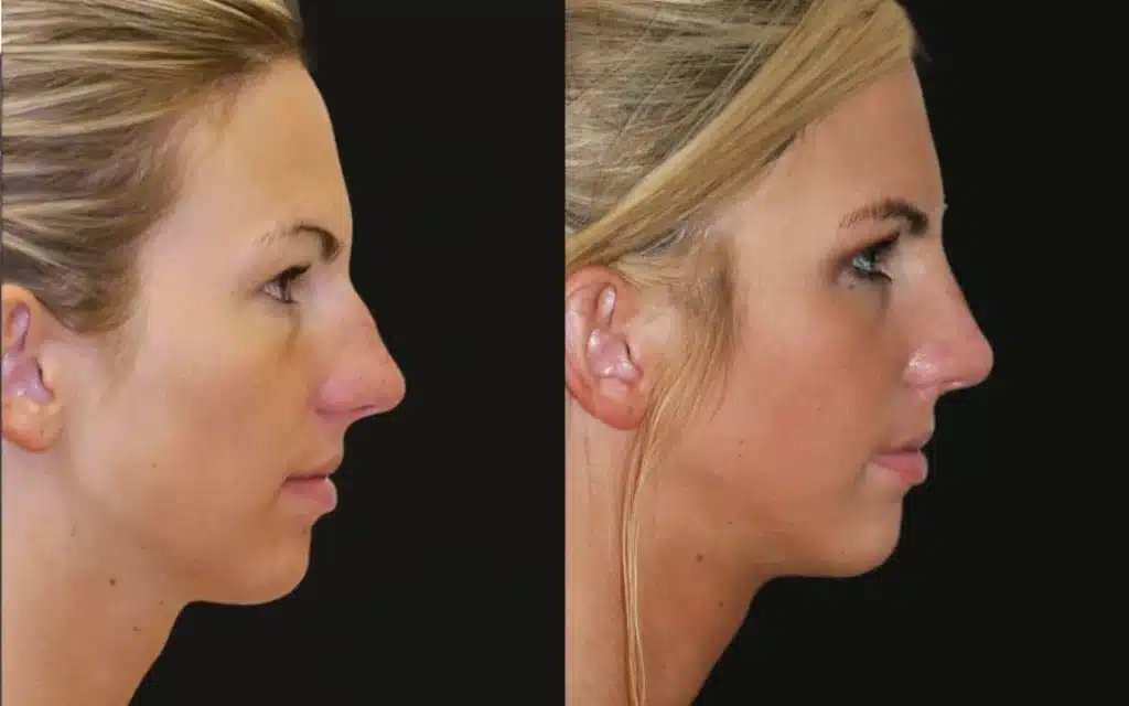 Rhinoplasty before and after photos by Noses and Necks NYC in New York, NY