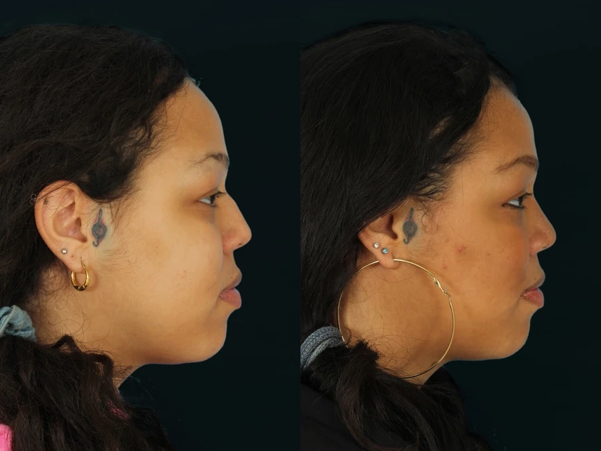 Rhinoplasty before and after photos by Noses and Necks NYC in New York, NY