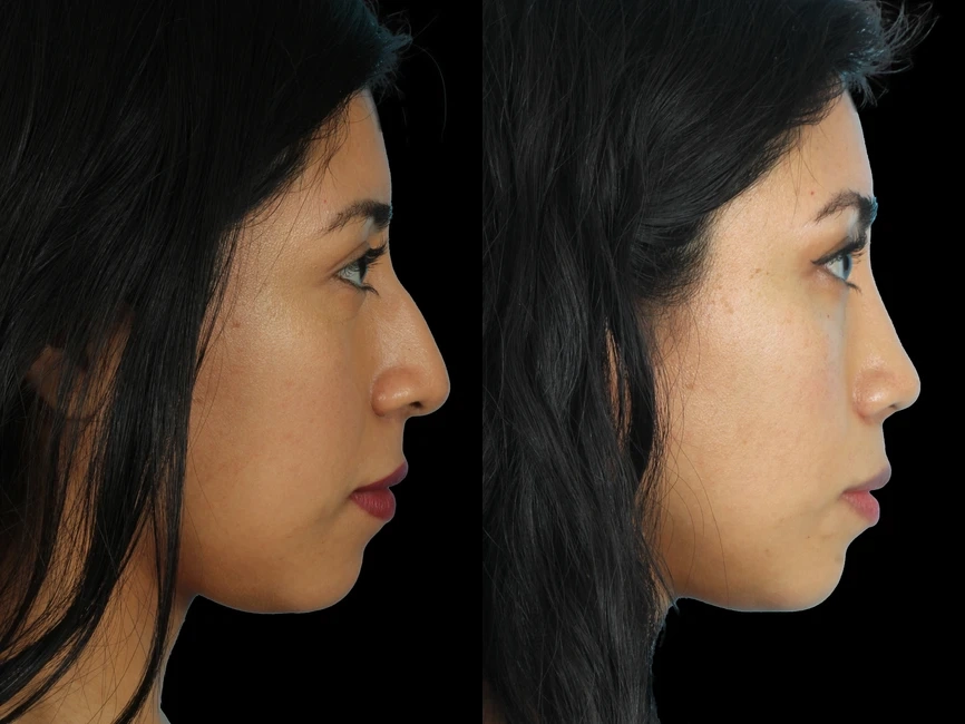 Rhinoplasty before and after photos by Noses and Necks NYC in New York, NY