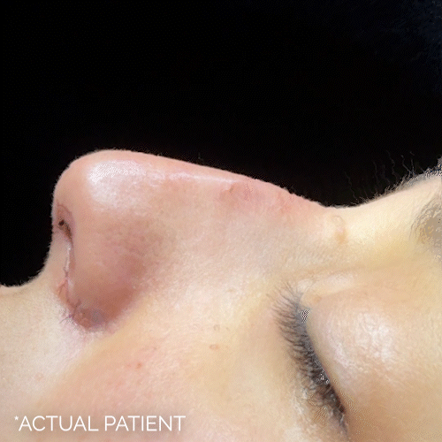 Rhinoplasty before and after photos by Noses and Necks NYC in New York, NY