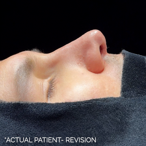 Rhinoplasty before and after photos by Noses and Necks NYC in New York, NY