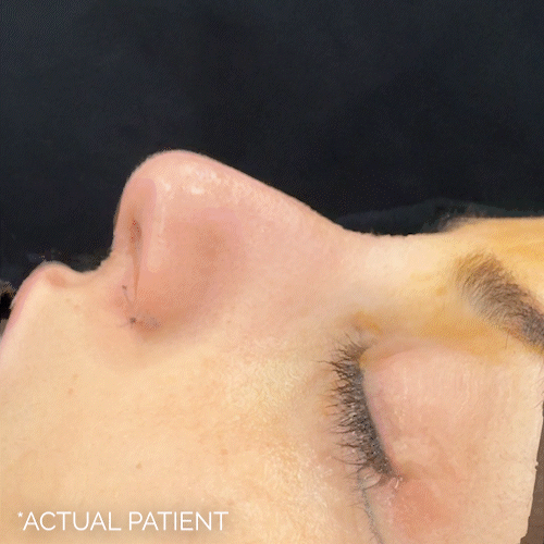 Rhinoplasty before and after photos by Noses and Necks NYC in New York, NY
