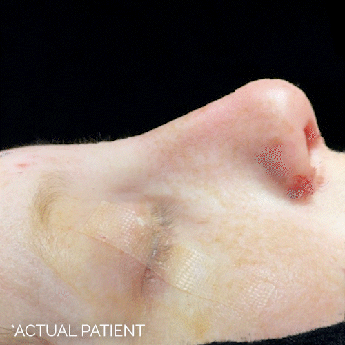 Rhinoplasty before and after photos by Noses and Necks NYC in New York, NY