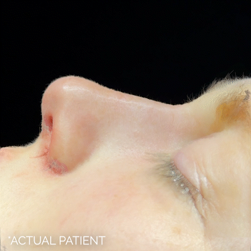 Rhinoplasty before and after photos by Noses and Necks NYC in New York, NY