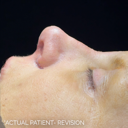Rhinoplasty before and after photos by Noses and Necks NYC in New York, NY