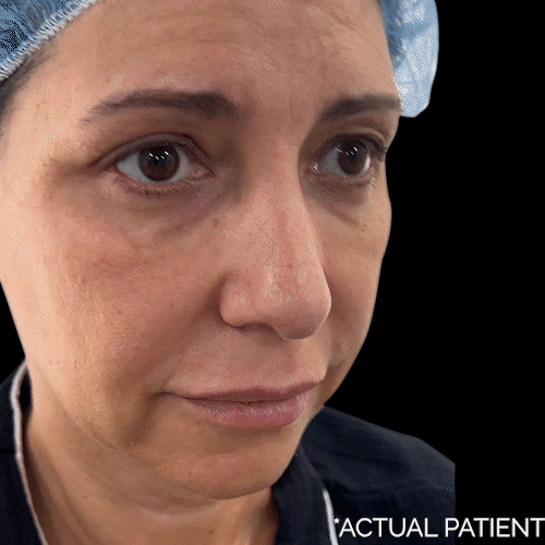 Aging Face before and after photos by Noses and Necks NYC in New York, NY