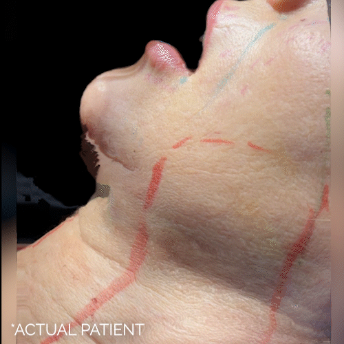 Aging Face before and after photos by Noses and Necks NYC in New York, NY
