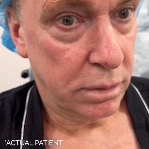 Aging Face before and after photos by Noses and Necks NYC in New York, NY
