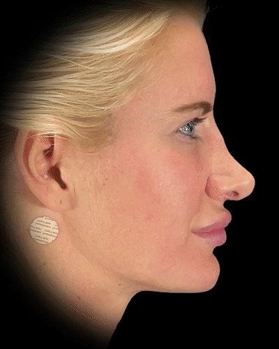 3D simulation of a plastic surgery results