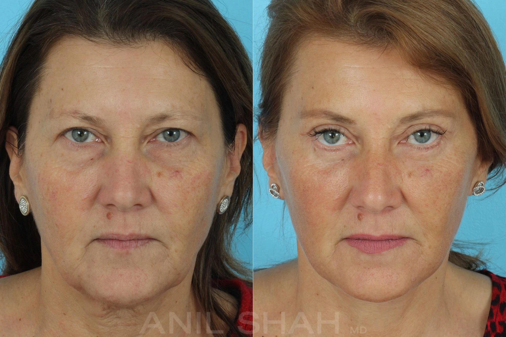 5-layer neck and facelift before and after photo by Anil R. Shah MD FACS