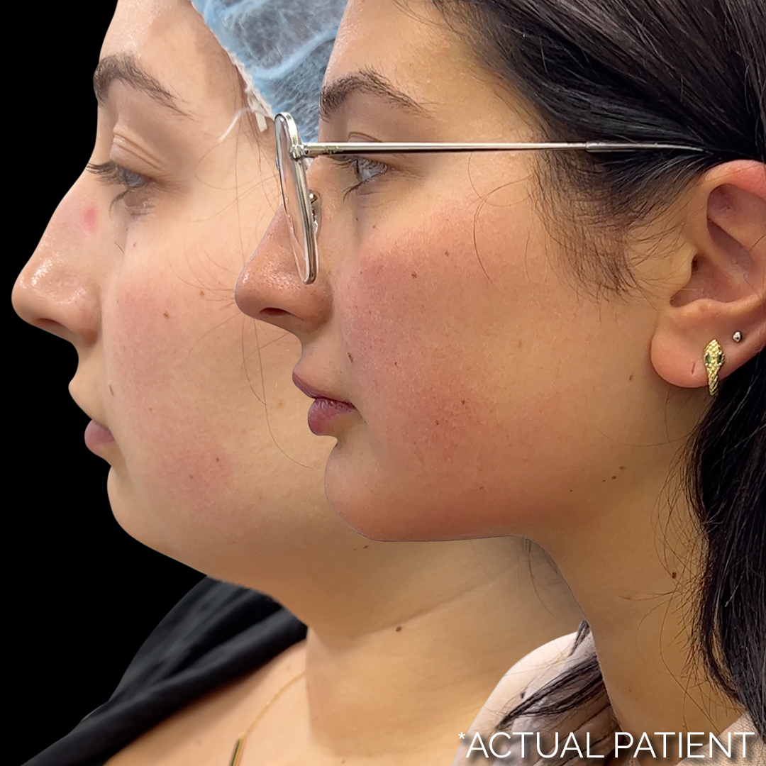 5-Layer neck lift procedure before and after photo