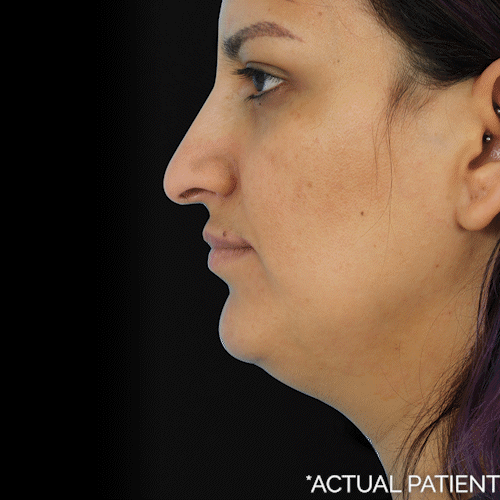 5D nose and five layer neck results