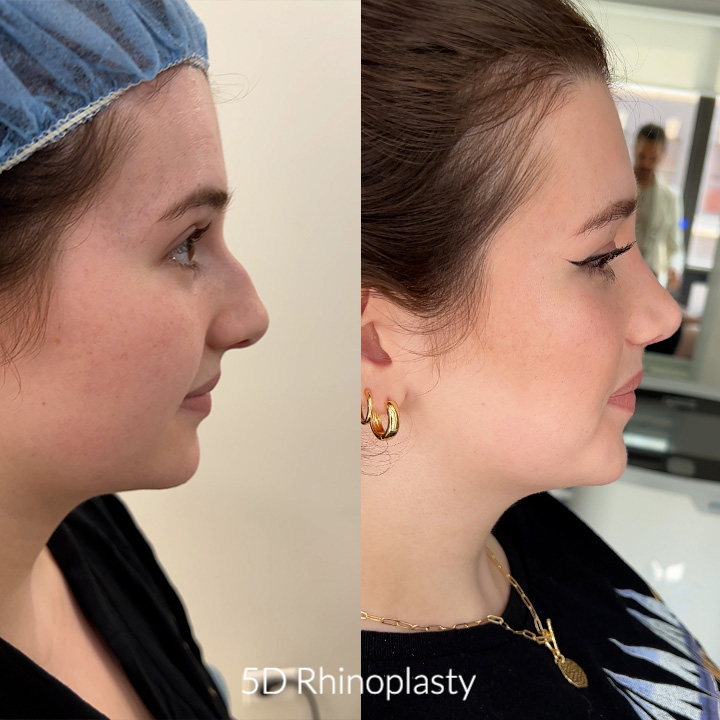 5D rhinoplasty before and after photo