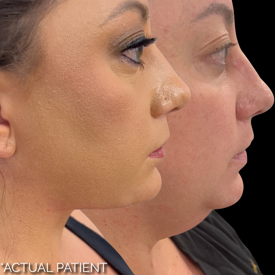 Actual 5-layer neck lift patient before and after photo