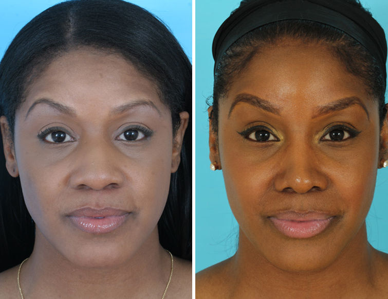 african american rhinoplasty pictures african american rhinoplasty pictures
