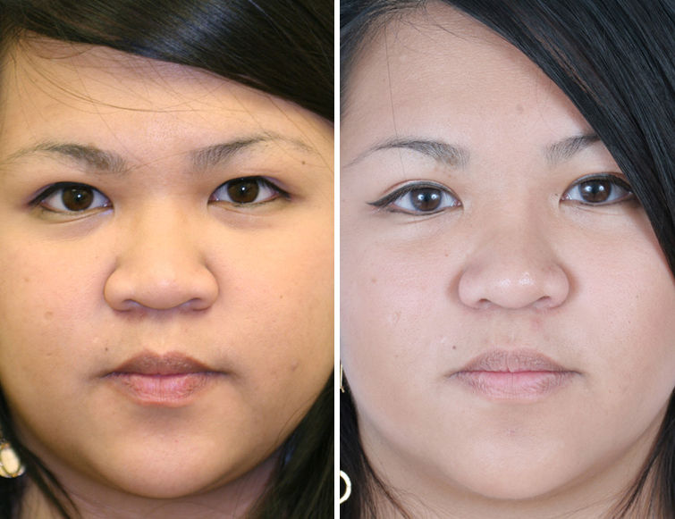 asian rhinoplasty pictures asian rhinoplasty pictures