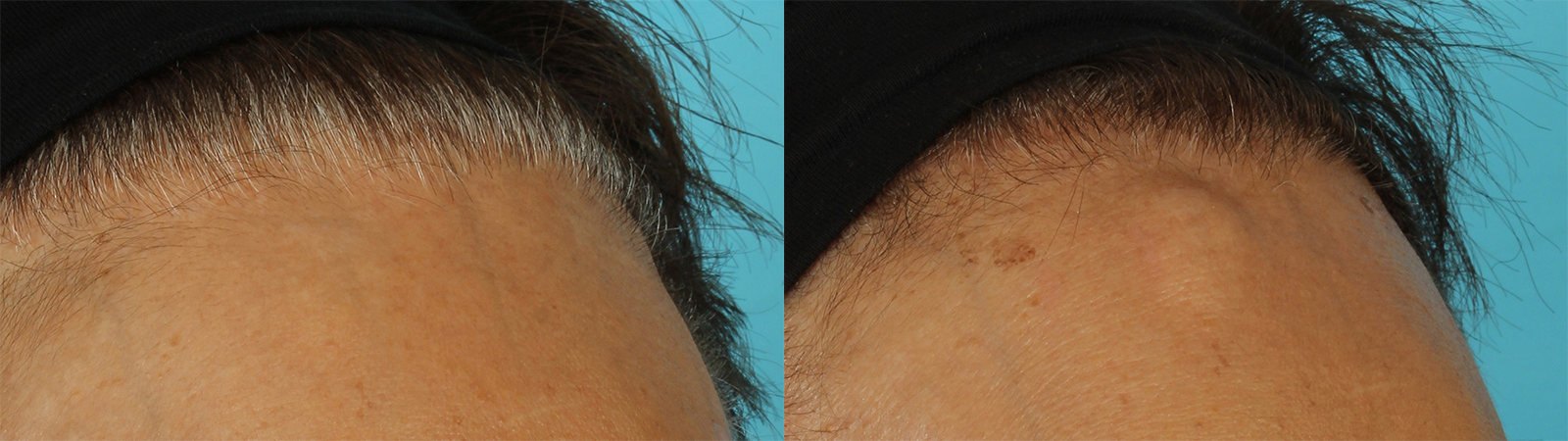 Bump removal before and after photo