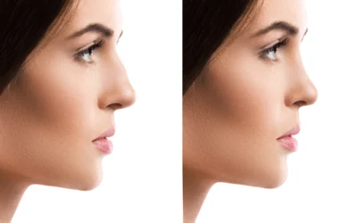 Advancements in Crooked Nose Correction: Suture Suspension Technique