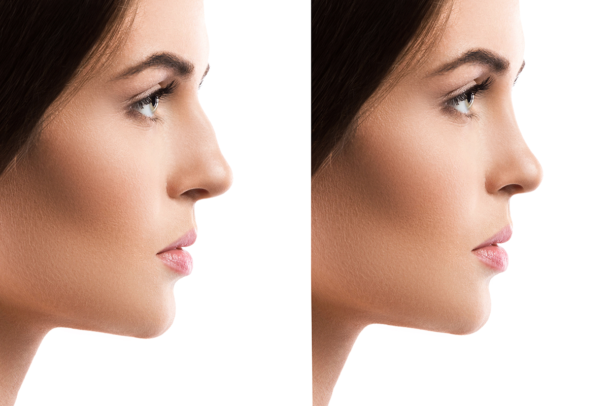 comparison of female face after rhinoplasty