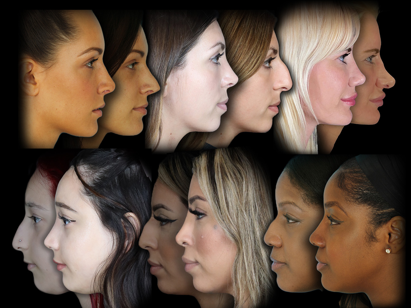 Ethnic rhinoplasty before and after results