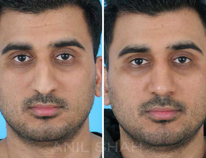indian rhinoplasty pictures indian rhinoplasty pictures