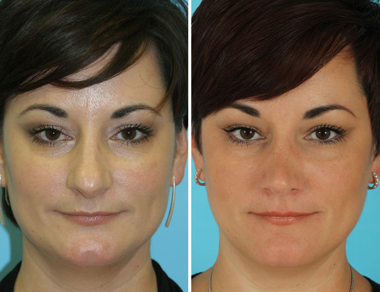 latin american rhinoplasty pictures latin american rhinoplasty pictures