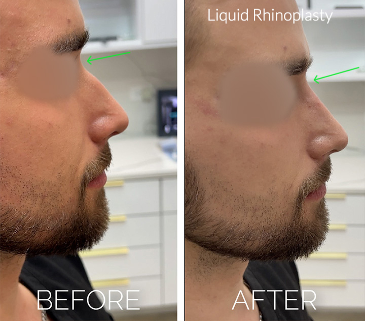 Liquid rhinoplasty before and after photo