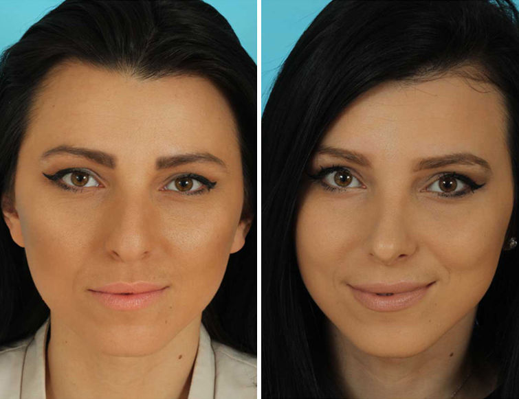 middle eastern rhinoplasty pictures middle eastern rhinoplasty pictures