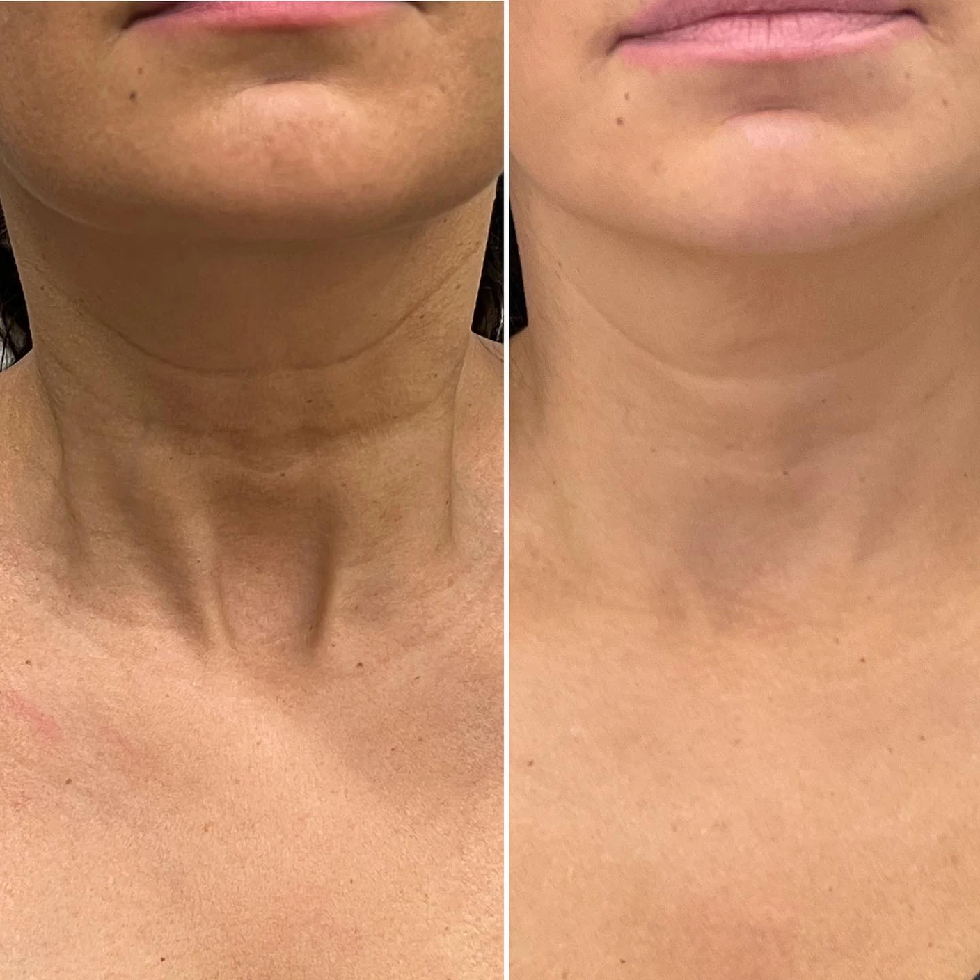 Non-surgical neck lift before and after photo