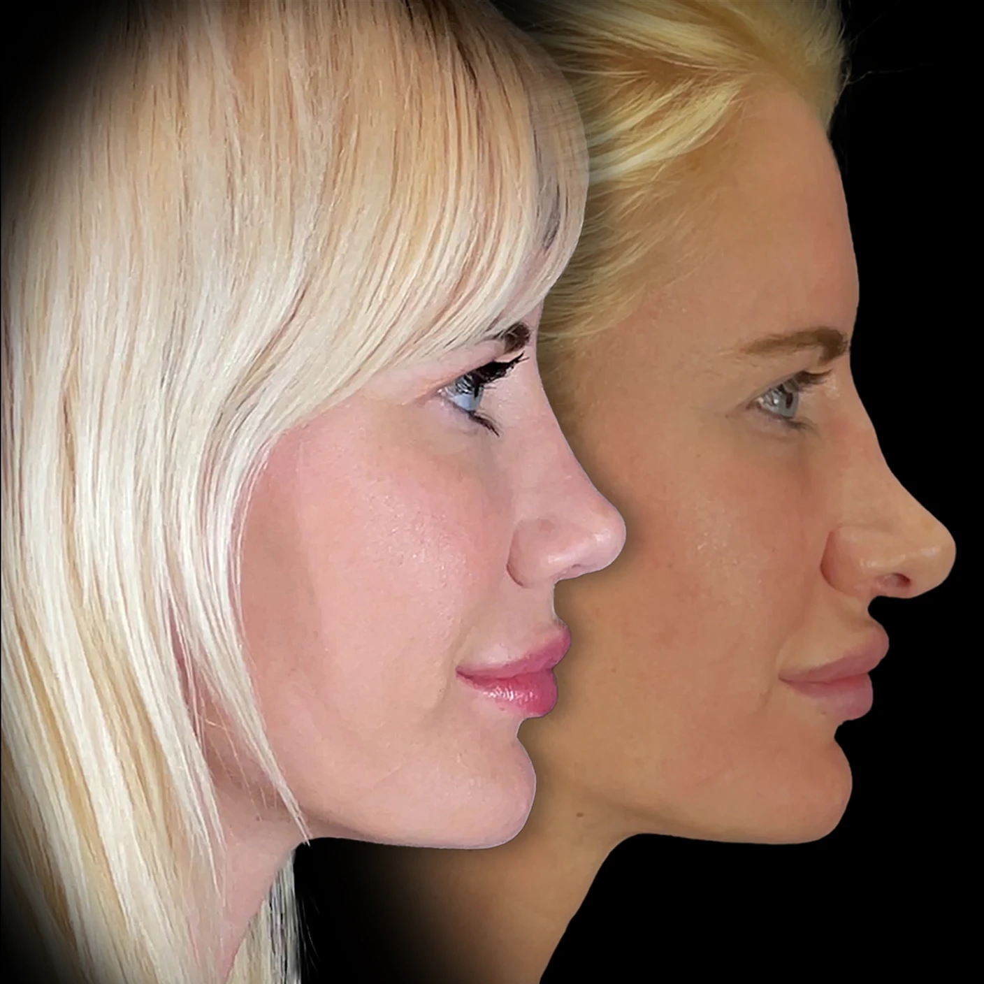 Revision rhinoplasty before and after photo Revision rhinoplasty before and after photo
